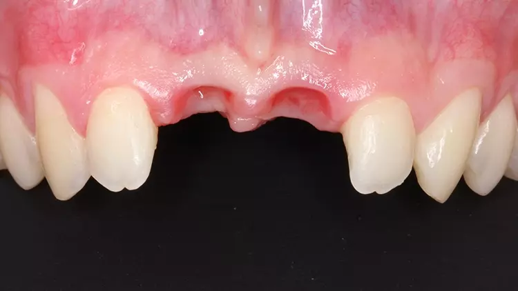 Abb. 5b: Intraalveoläre physiologische Regeneration und Knochengewinnung
nach 6 Wochen.