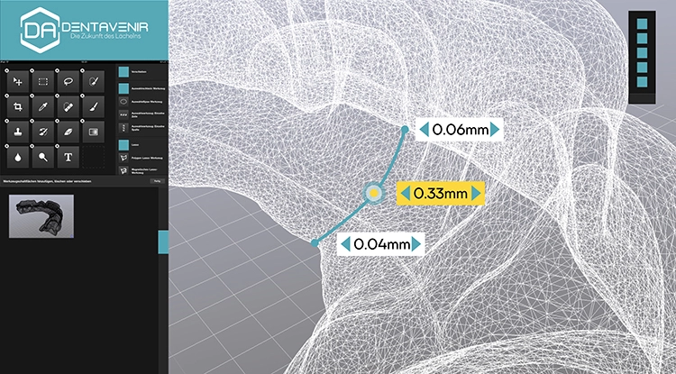 Abb. 3b: Dentavenir Software Screen – Polygondetail.
