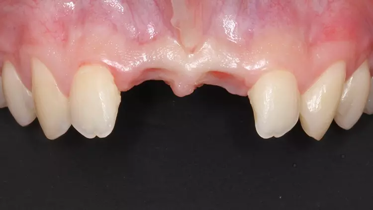 Abb. 5c: Intraalveoläre physiologische Regeneration und Knochengewinnung
nach 12 Wochen.