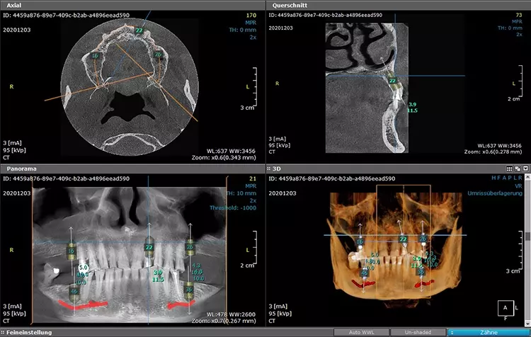 Abb. 5c: Implantatplanung.