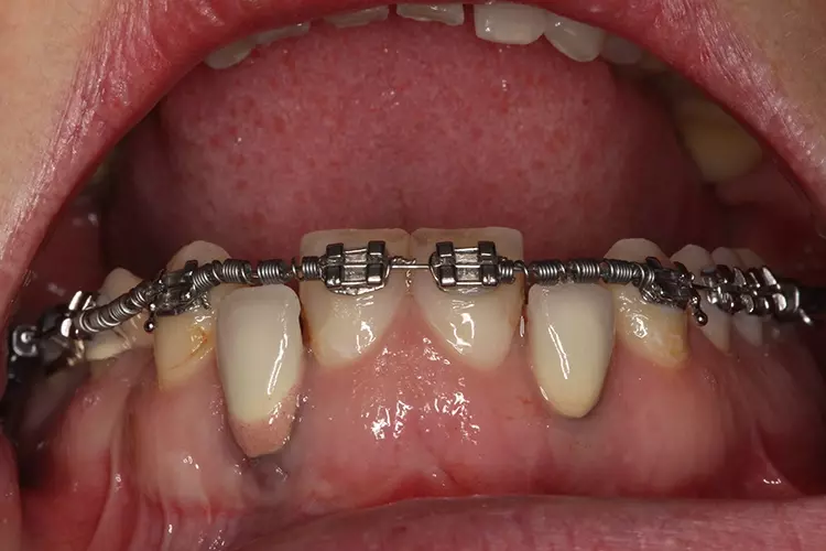 Abb. 5d: KFO-Therapie.