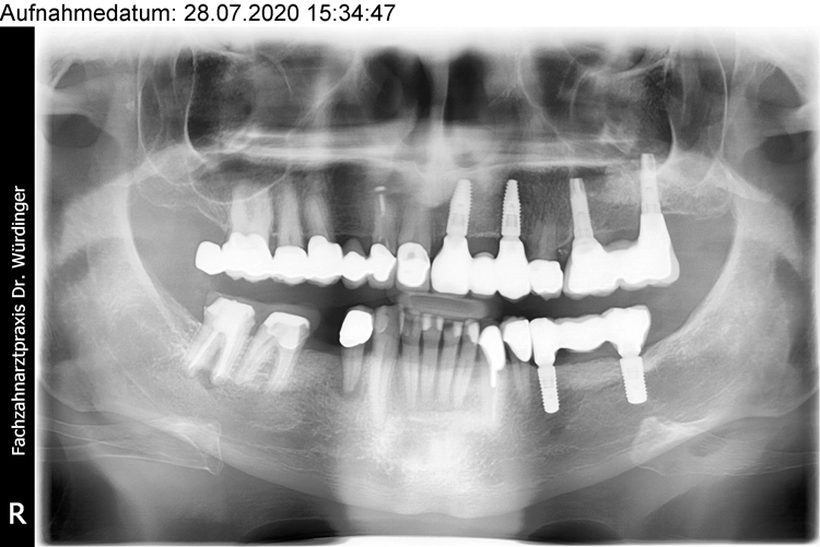 Abb. 20: Röntgenansicht nach Einbringen des definitiven Zahnersatzes.