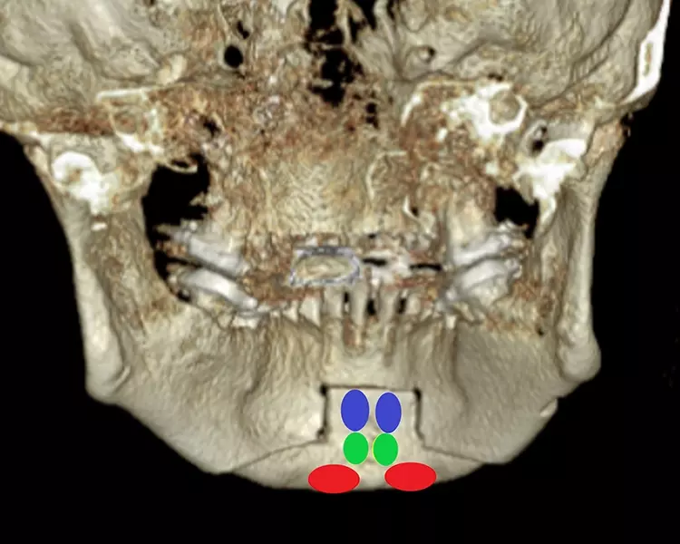 Abb. 6: Osteotomielinie der Kinnplastik mittels Schubladen-Flügeltechnik
im DVT post Op mit schematischer Darstellung der lingualen Ansätze des
M. digastricus venter anterior (rot), M. geniohyoideus (grün) und M. genioglossus (blau).