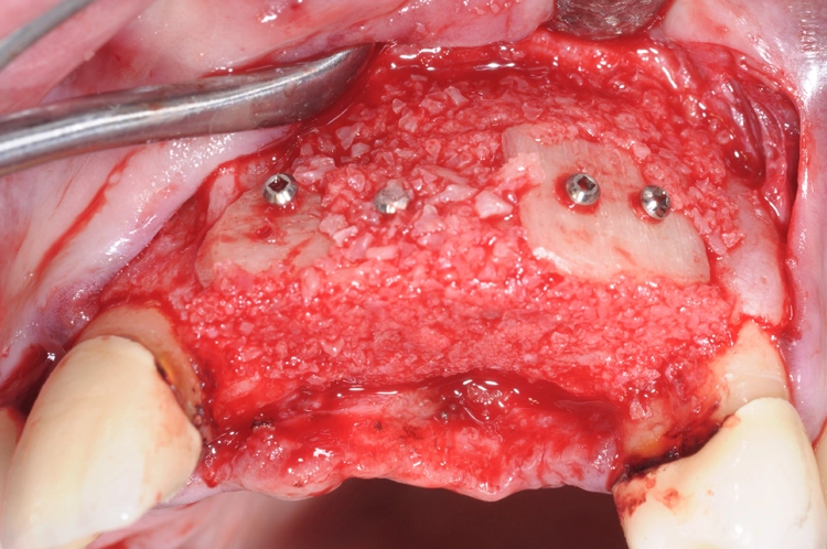 Abb. 6: Auffüllung der Spalträume mit allogenen Knochengranulaten (maxgraft®, Straumann).