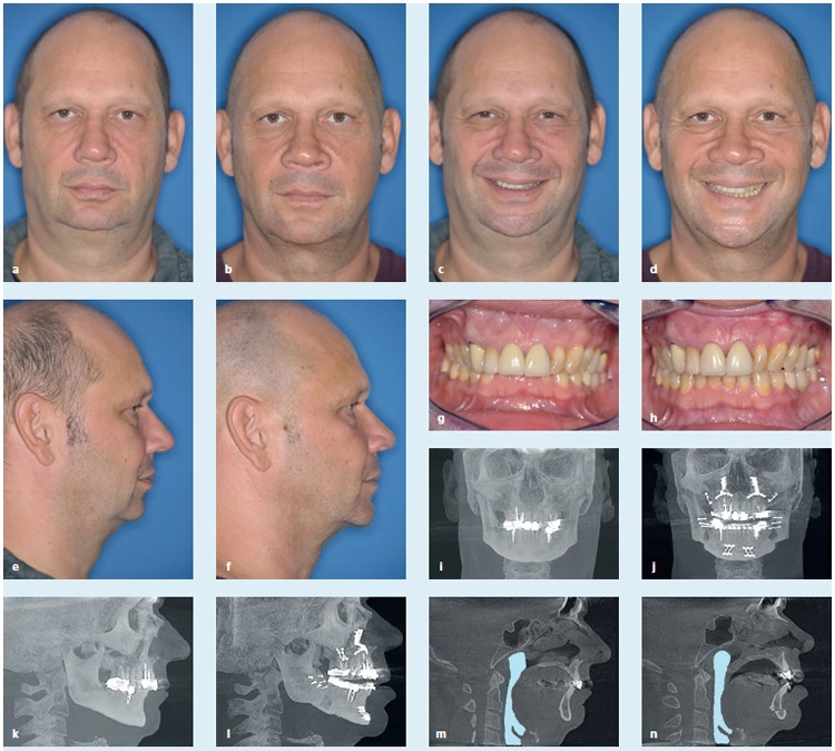 Abb. 6: Patient mit schwerer obstruktiver Schlafapnoe und CPAP-Intoleranz, Klasse-II-Okklusion mit tiefem Biss, Therapie durch ein bimaxilläres Rotationsadvancement
mit Kinnrandverschiebung und gleichzeitiger Korrektur der Bisslage.
a: Patient en face prä op.
b: Patient en face 2 Jahre post op.
c: Patient en face lächelnd prä op.
d: Patient en face lächelnd 2 Jahre post op.
e: Profil prä op.
f: Profil 2 Jahre post op.
g: Okklusion prä op.
h: Okklusion 2 Jahre post op.
i: DVT en face prä op.
j: DVT en face 6 Wochen post op.
k: DVT Profil prä op.
l: DVT Profil 6 Wochen post op
mit OP-Splint.
m: PAS-Markierung im DVT prä op.
n: PAS-Markierung im DVT 6
Wochen post op, deutliche
Vergrößerung von PAS und
Zungenfunktionsraum.