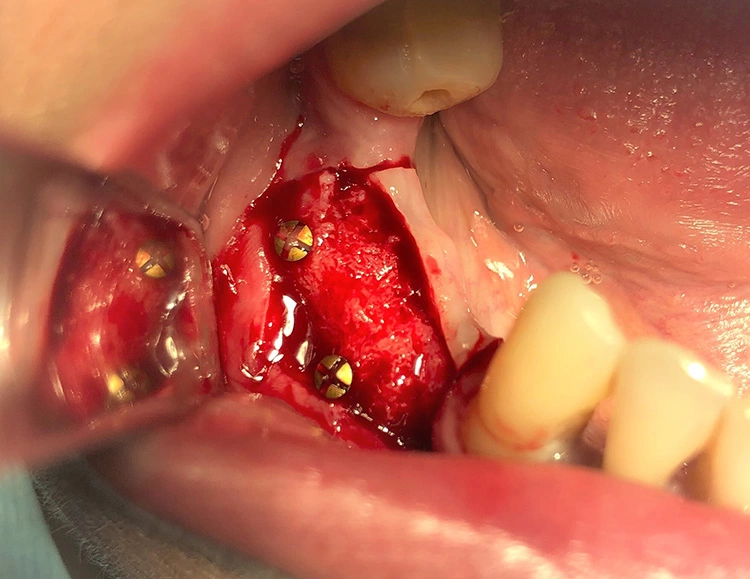 Abb. 6: Knochenangebot vor Implantation mit erkennbarer stattgefundener Resorption.