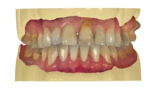 Digitale Erstellung der Meistermodelle mit Steckstümpfen mithilfe der 3Shape Modelbuilder-Software (Dental System 2020 V20.1).
