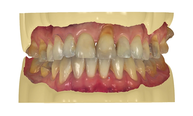 Digitale Erstellung der Meistermodelle mit Steckstümpfen mithilfe der 3Shape Modelbuilder-Software (Dental System 2020 V20.1).
