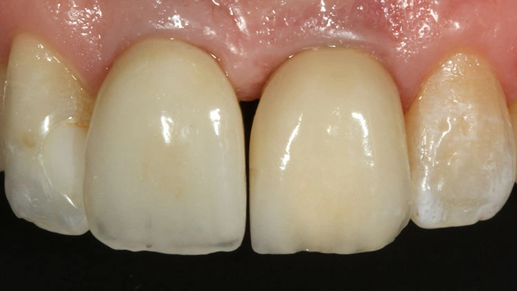 Abb. 6: 6 Wochen später wurde das PMMA-Provisorium durch eine definitive keramische Implantatkrone ersetzt. Die Abbildung zeigt die Situation 1 Jahr nach dem Kompositanbau an die Implantatkrone 21.