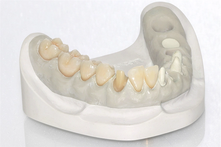 Abb. 5: Modell mit aufgesetztem Lithium-Disilikat-Abutment an 43.