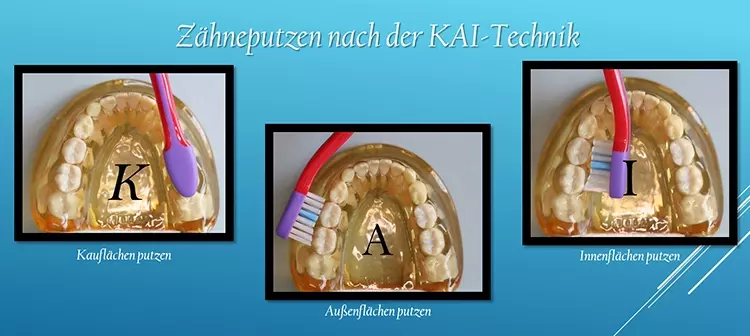 Abb. 6: Zähneputzen nach der KAI-Technik: K - Kaufläche, A - Außenfläche, I – Innenfläche.