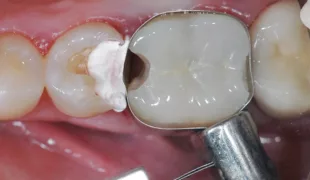 Matrize mit Teflonband
