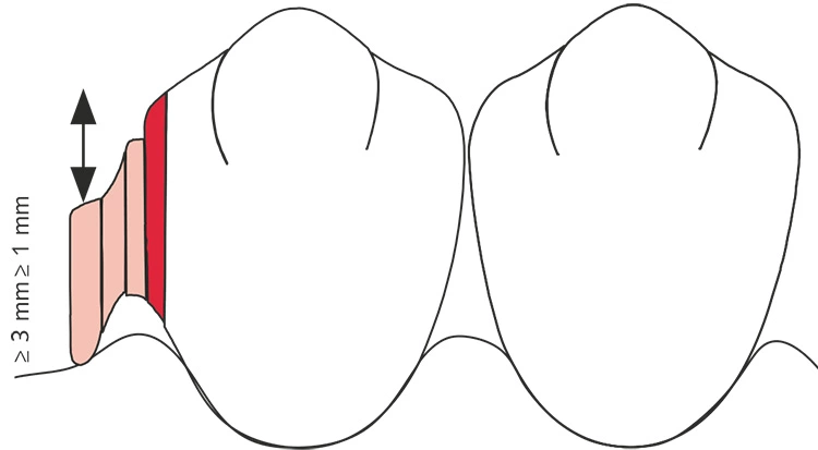 Abb. 6: Das Adhäsivattachment bietet eine Führungsfläche für das Interdentalbürstchen.
Das Stabgeschiebe kann bis auf 3 mm gekürzt werden. Okklusal wird
mindestens 1 mm Platz für ein unverblendetes Sekundärgerüst (Kaufläche
teilweise in Metall), besser aber 2 mm für ein verblendetes Gerüst benötigt [18].