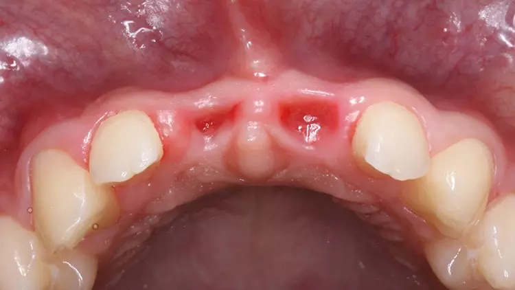 Abb. 6a: Extraalveoläre laterale Atrophie 6 Wochen nach Zahnverlust.