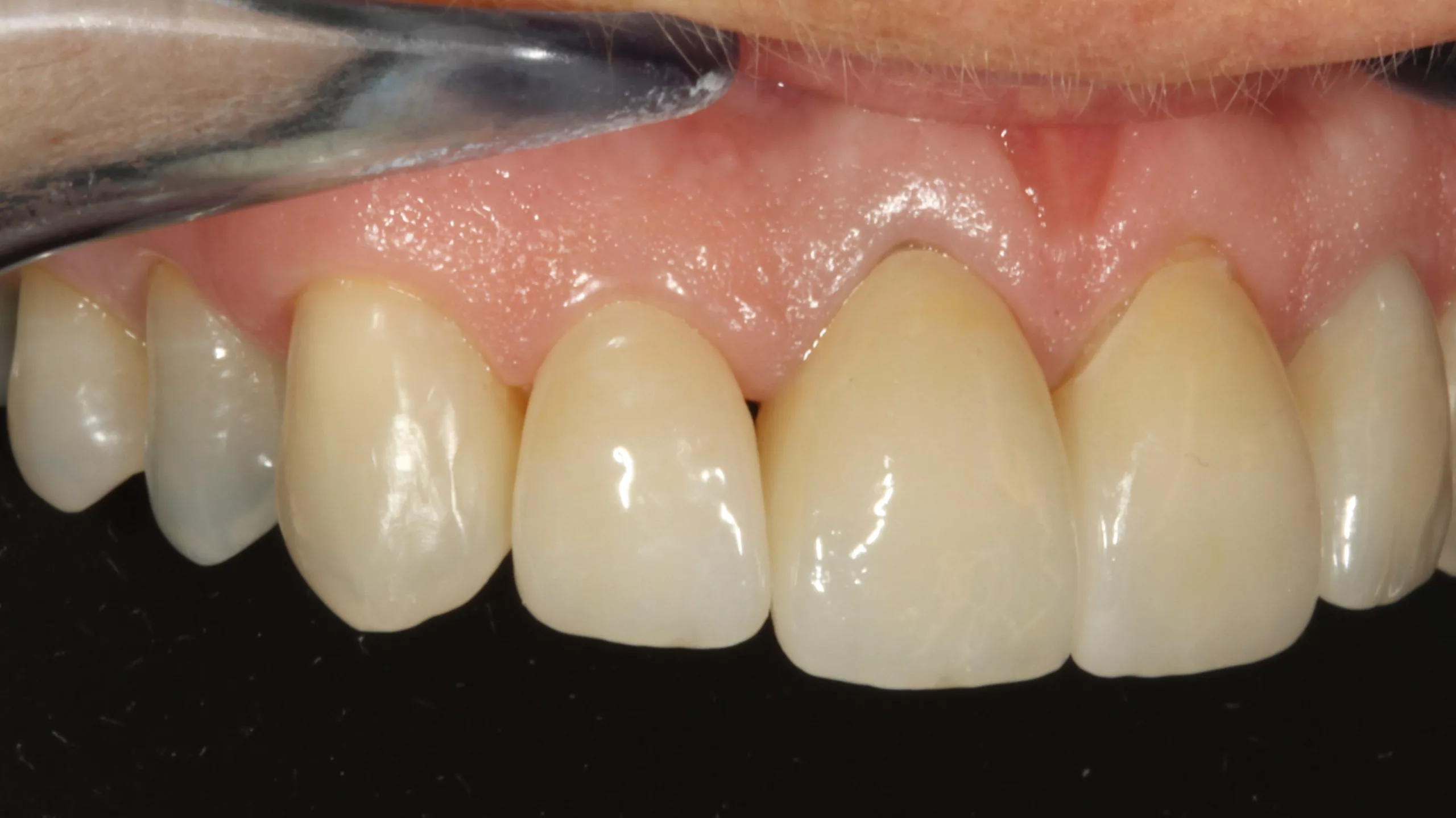 Abb. 35: Die eingesetzte Arbeit aus labial diskret verblendetem Vollzirkon.