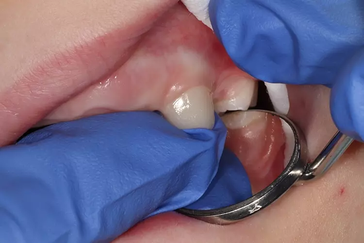 Abb. 6b: Anprobe und Anpassung von Zahn und der edelweiss Pediatric Crown
vor dem Bonding-Verfahren