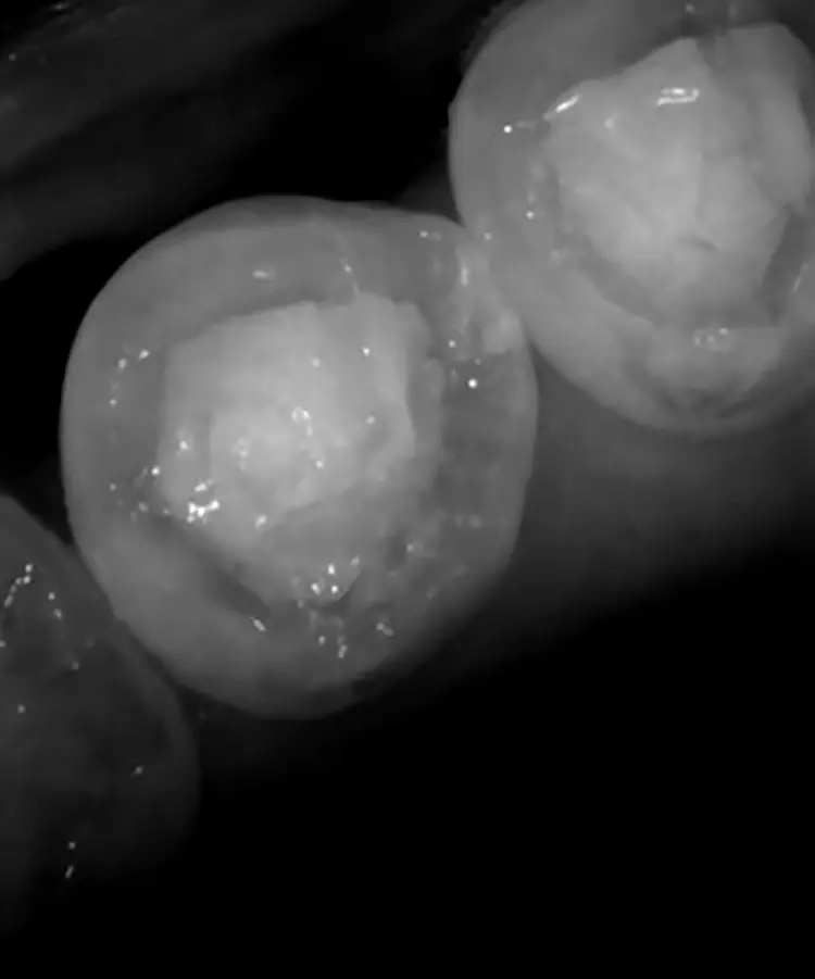Abb. 6b: Ein Intraoralscan, der die Oberflächenkaries erkennen lässt.