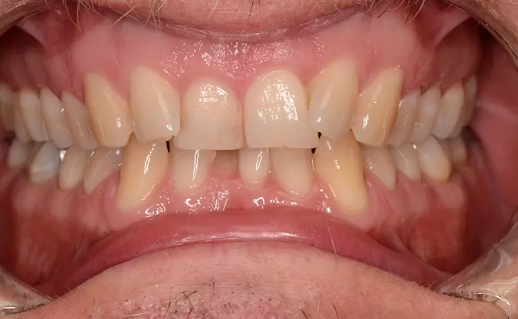 Abb. 6d: Okklusion.