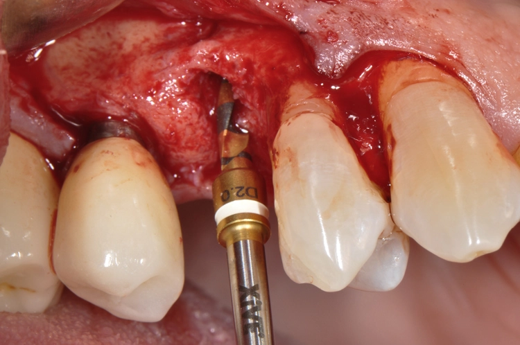 Abb. 6: Aufbereitung des Implantatbetts mit maximaler Schonung der vestibulären Knochenlamelle. Die Anodisierung der Bohrer und die Lasermarkierung sorgen
für eine gute Sichtbarkeit während der Aufbereitung.