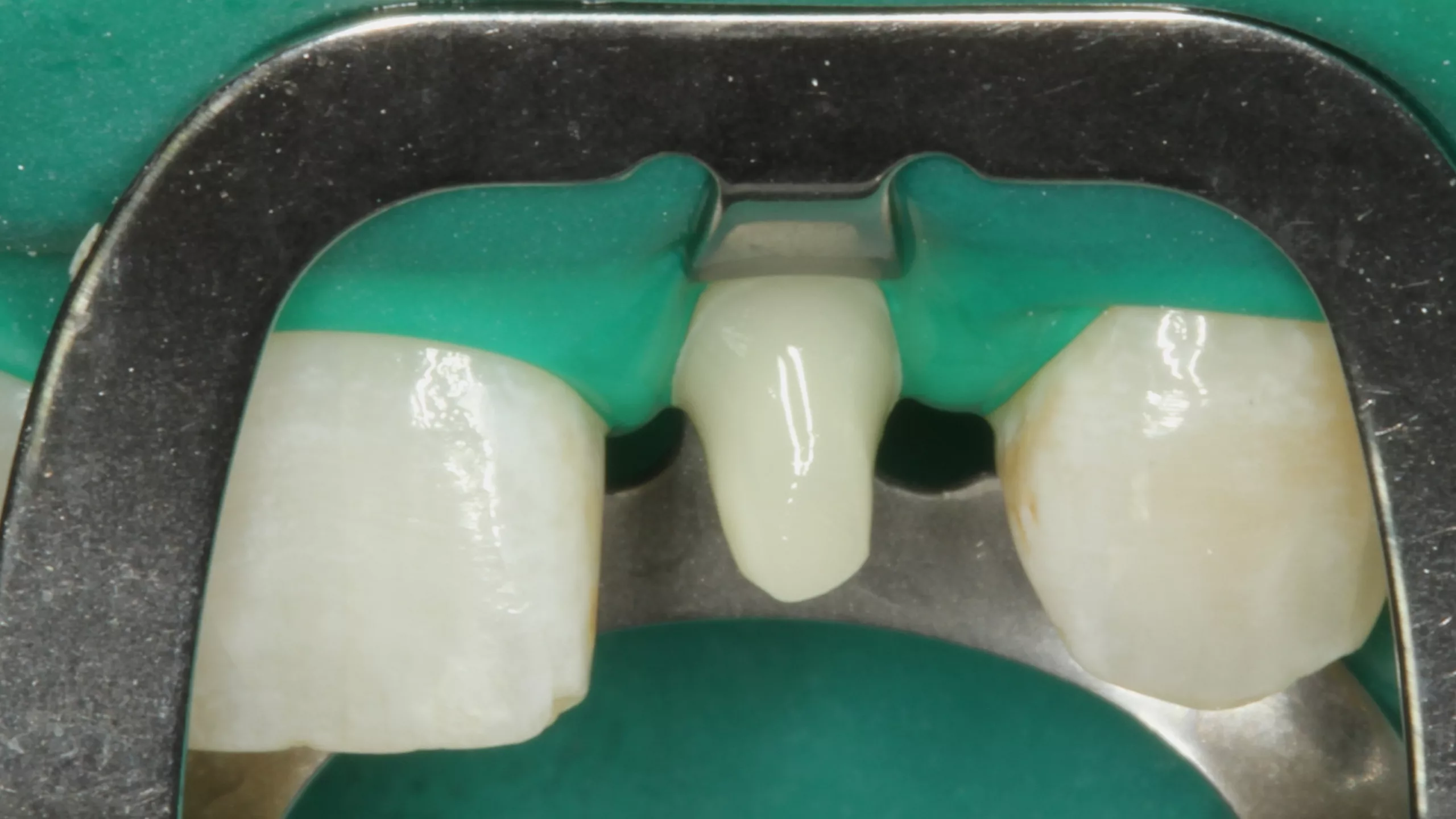 Abb. 24: Einwirken des Visalys Tooth Primers für 20 Sek. (labiale Ansicht).