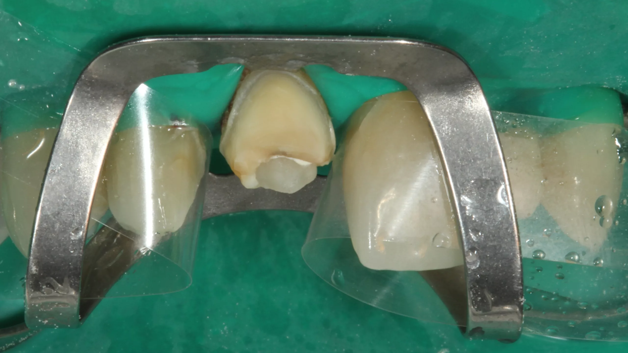 Abb. 33: Reste des Aufbaumaterials in Zahn 11 nach unfallbedingter Fraktur des Provisoriums samt Aufbau.