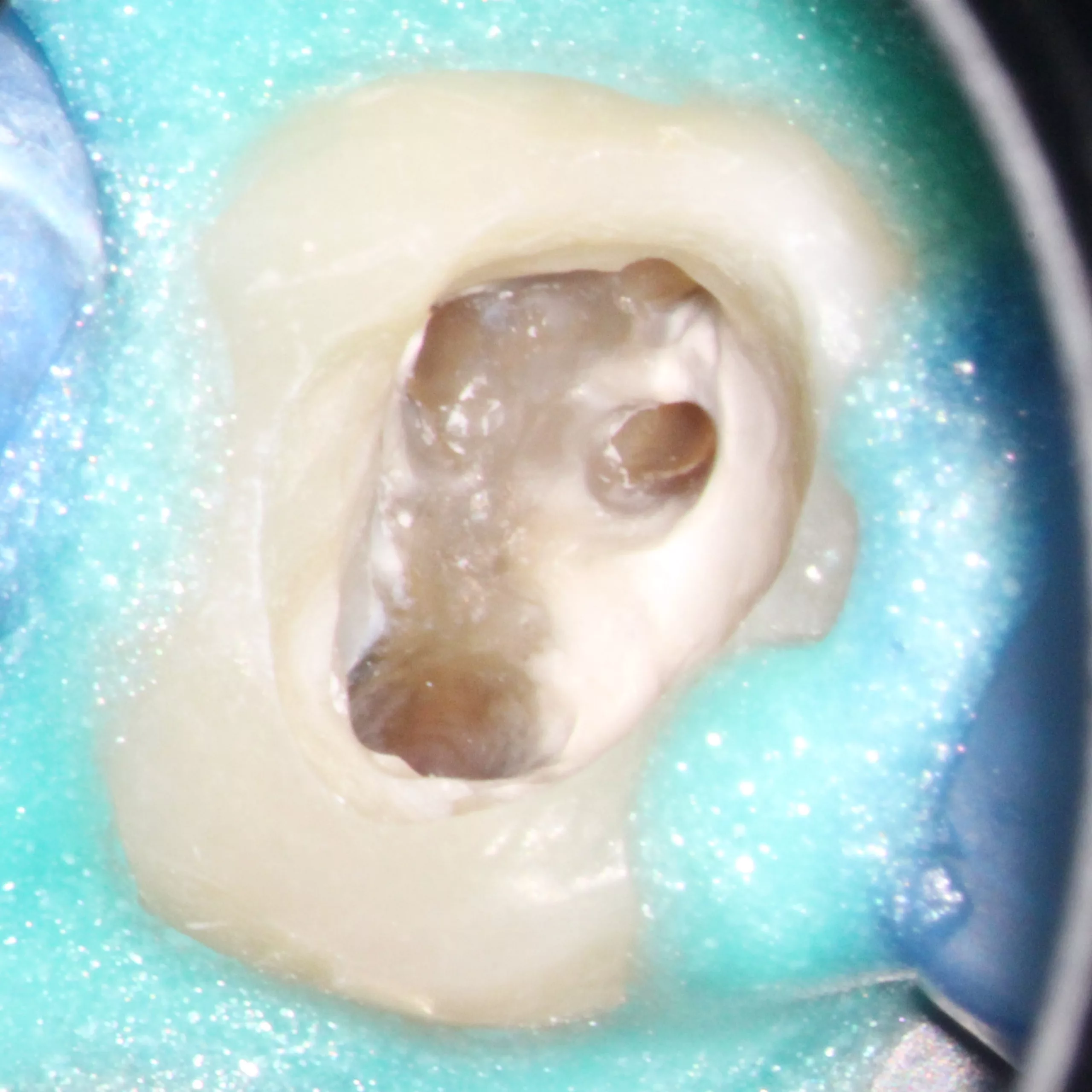 Abb. 54: Kanalsystem in Zahn 26 unmittelbar vor der Wurzelkanalfüllung. Ansicht durch das OP-Mikroskop Zeiss Pro Ergo.