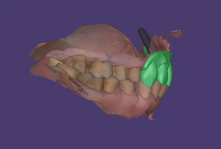 Abb. 6: Implantatplanung: Das Wax-up aus Smile
Creator übertragen in exoplan zur Identifizierung der
optimalen Implantatposition aus prothetischer Sicht.