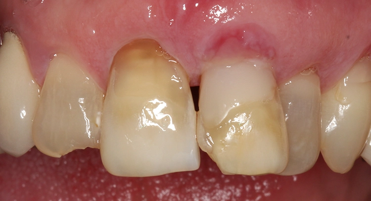 Abb. 7: Situation labial 14 Tage nach dem parodontalchirurgischen Eingriff.