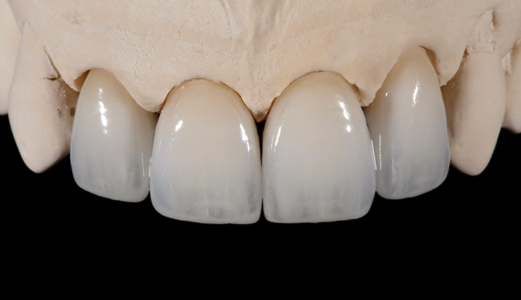 Abb. 7: Finalisierte IPS e.max ZirCAD Prime-Kronen auf dem Modell.