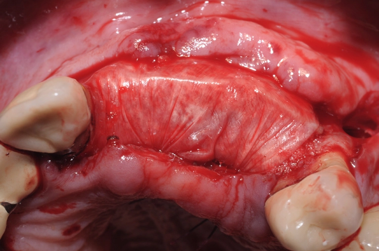 Abb. 7: Abdeckung des Augmentats mit einer nativen Kollagenmembran (Jason® membrane, Straumann).