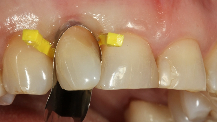 Abb. 7: Verschalung und Isolierung des Defektes mit einer Unica anterior Matrize, adaptiert mit 2 Composi-Tight 3D Fusion Wedges.