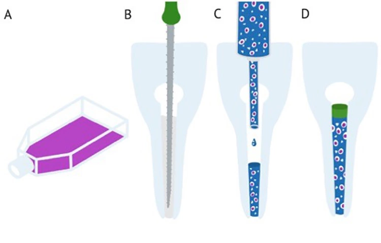 Abb. 8: Die Zelltransplantation
A) Stammzellen werden beispielsweise aus Weisheitszähnen des Patienten isoliert und in vitro expandiert.
B) Der Wurzelkanal des Empfängerzahnes muss aufbereitet und desinfiziert werden.
C) Die Stammzellen werden, gemeinsam mit Signalmolekülen, in einem Gerüstmaterial injiziert.
D) Anschließend wird die Kavität adhäsiv verschlossen. Die Zellen können proliferieren, differenzieren und ggf. mineralisieren.
