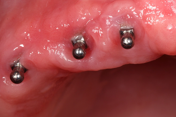 Abb. 7: MDI-Implantate im OK nach Einheilung.