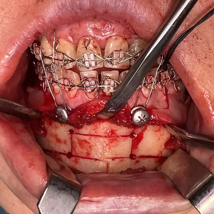 Abb. 7: Kinnplastik mittels Schubladen-Flügeltechnik.
a: Anzeichnen der Osteotomielinien und Eckpunkte entsprechend der DVT-Planung.