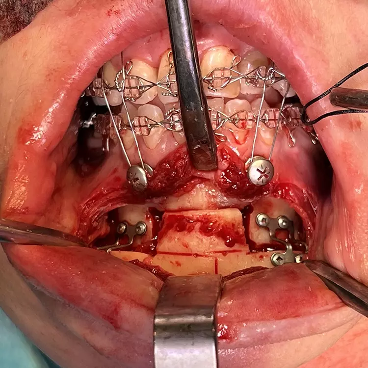 Abb. 7: Kinnplastik mittels Schubladen-Flügeltechnik. c: Vorverlagerung und Osteosynthese mittels kalibrierter Mikrokinnplatten nach Lindorf, leichte
Abschrägung des Segmentes an der oberen Kante zur Anpassung der Stufe entsprechend der
gewünschten Anhebung der Sublabialfalte.
