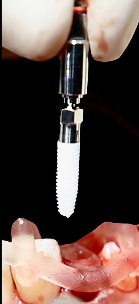 Abb. 7: Implantatinsertion eines Neodent
ZI Implantats Ø 4,3, Länge 13 mm.