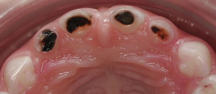 Abb. 7a: Inaktive und aktive Dentinkaries in der Gegenüberstellung am Beispiel der ECC. Inaktive kariöse Dentinläsionen in der Oberkiefer-Front: Die Läsionen sind sondenhart, eher glatt und dunkelbraun bis schwarz. Deutliche aktive kariöse Dentinläsionen an den oberen Schneidezähnen.