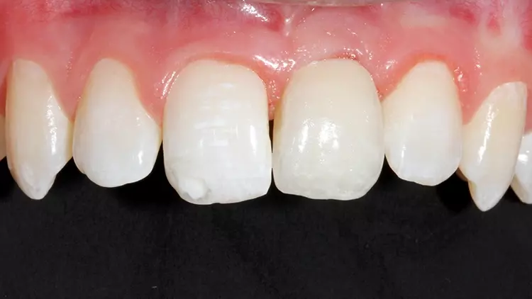 Abb. 7b: Prospektive Implantation mit Antizipieren des Restwachstums im Alter
von 19 Jahren (geänderte Prothetik); positiver Überschuss im Emergenzprofil für
weiteres Wachstum.