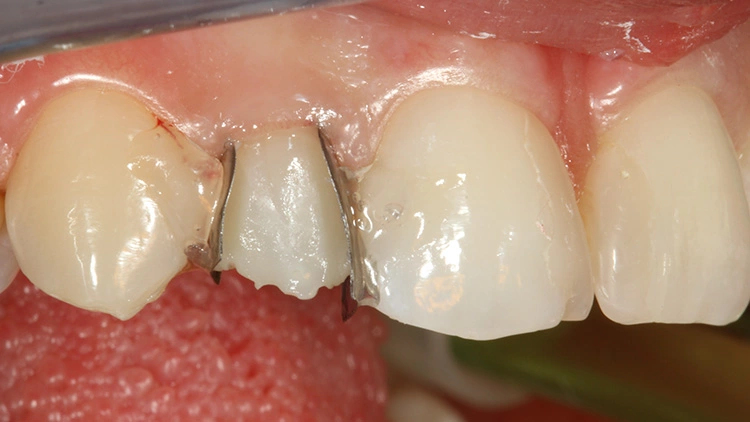 Abb. 19: Dentinkernaufbau an Zahn 12 mit A2 Dentin.