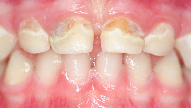Abb. 7b: Inaktive und aktive Dentinkaries in der Gegenüberstellung am Beispiel der ECC. Inaktive kariöse Dentinläsionen: Die Läsionen sind von Plaque bedeckt, das Dentin erweicht, die Farbe und Beschaffenheit ist eher gelblich und die Schmelzbereiche um die Dentinläsion herum sind kreidig-weiß.