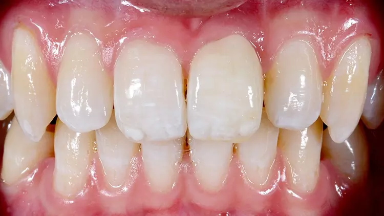 Abb. 7c: Prospektive Implantation mit Antizipieren des Restwachstums im Alter
von 23 Jahren (geänderte Prothetik); positiver Überschuss im Emergenzprofil für
weiteres Wachstum.