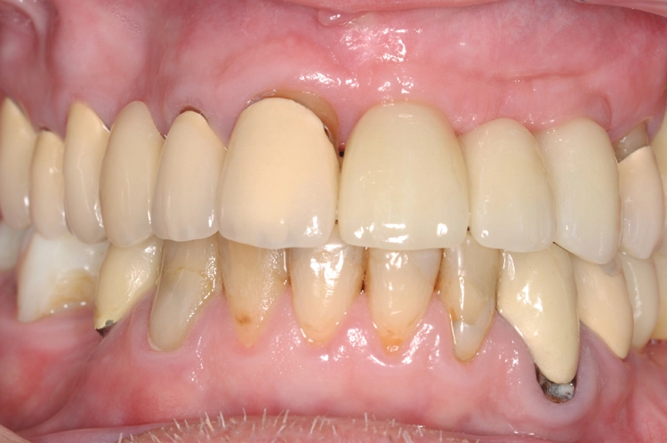 Abb. 18: Ansicht frontal: verschraubter definitiver Zahnersatz in regio 21-23, zwei Monate nach Freilegung.