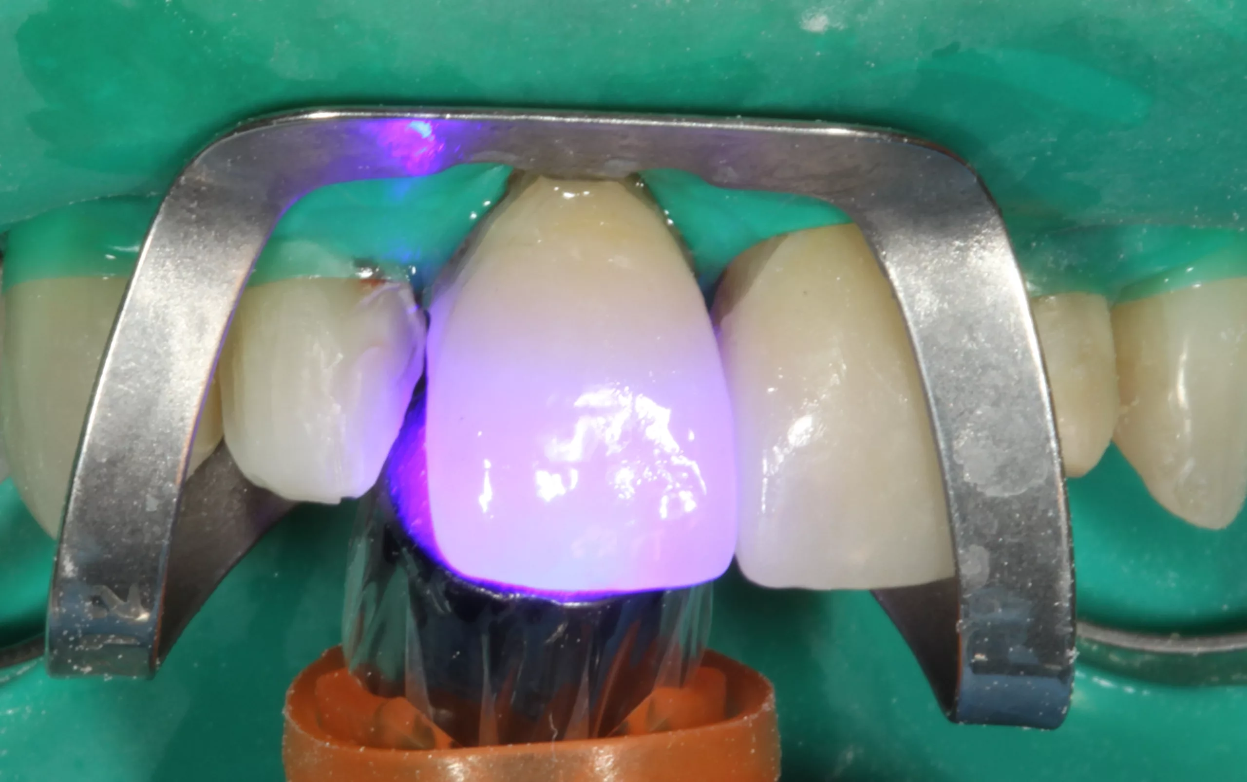 Abb. 34: Polymerisation von Visalys CemCore (ebenfalls in der Farbe A2/Universal) nach vollständiger Überschussentfernung der Kleberreste an Zahn 11.