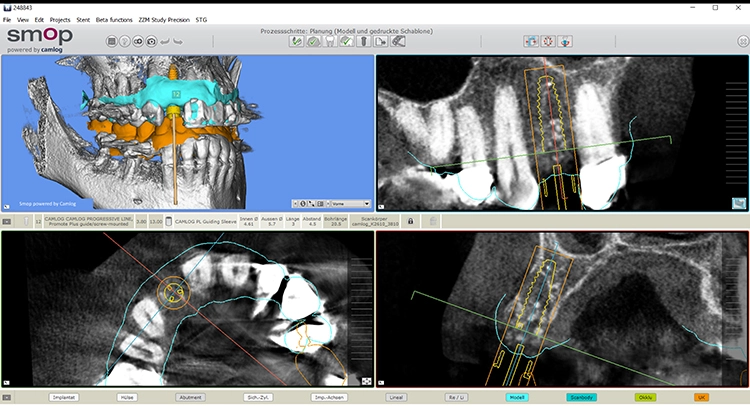 Abb. 12: Auswertung der 3D-Diagnostik zeigt ausreichende stabile knöcherne Verhältnisse in allen Ebenen.
