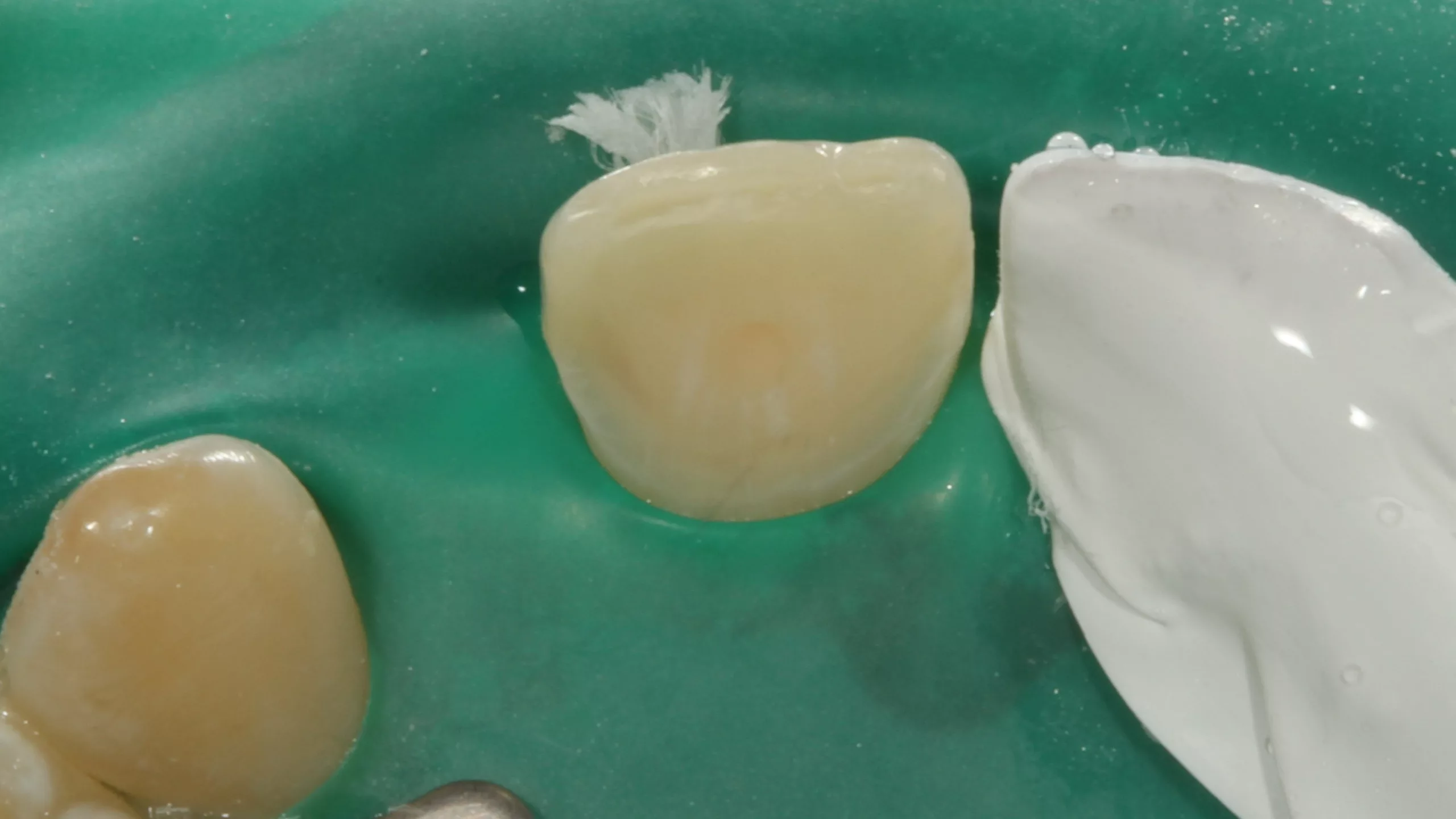 Abb. 44: Gruppenkofferdammisolierung der Klebeflächen. Ansicht von inzisal. Zahn 11 ist mit einem Stück Teflonband geschützt.