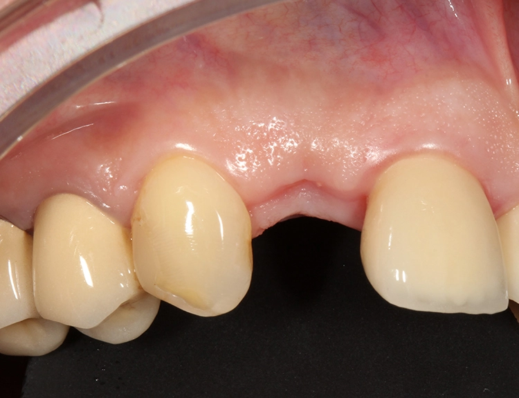 Abb. 13: Klinische Situation vor Implantation.