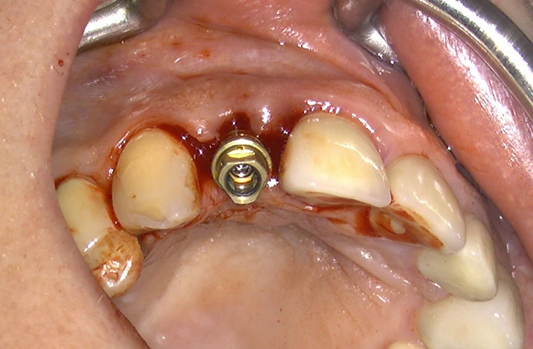 Abb. 19: Finale Position des Implantats in regio 12.