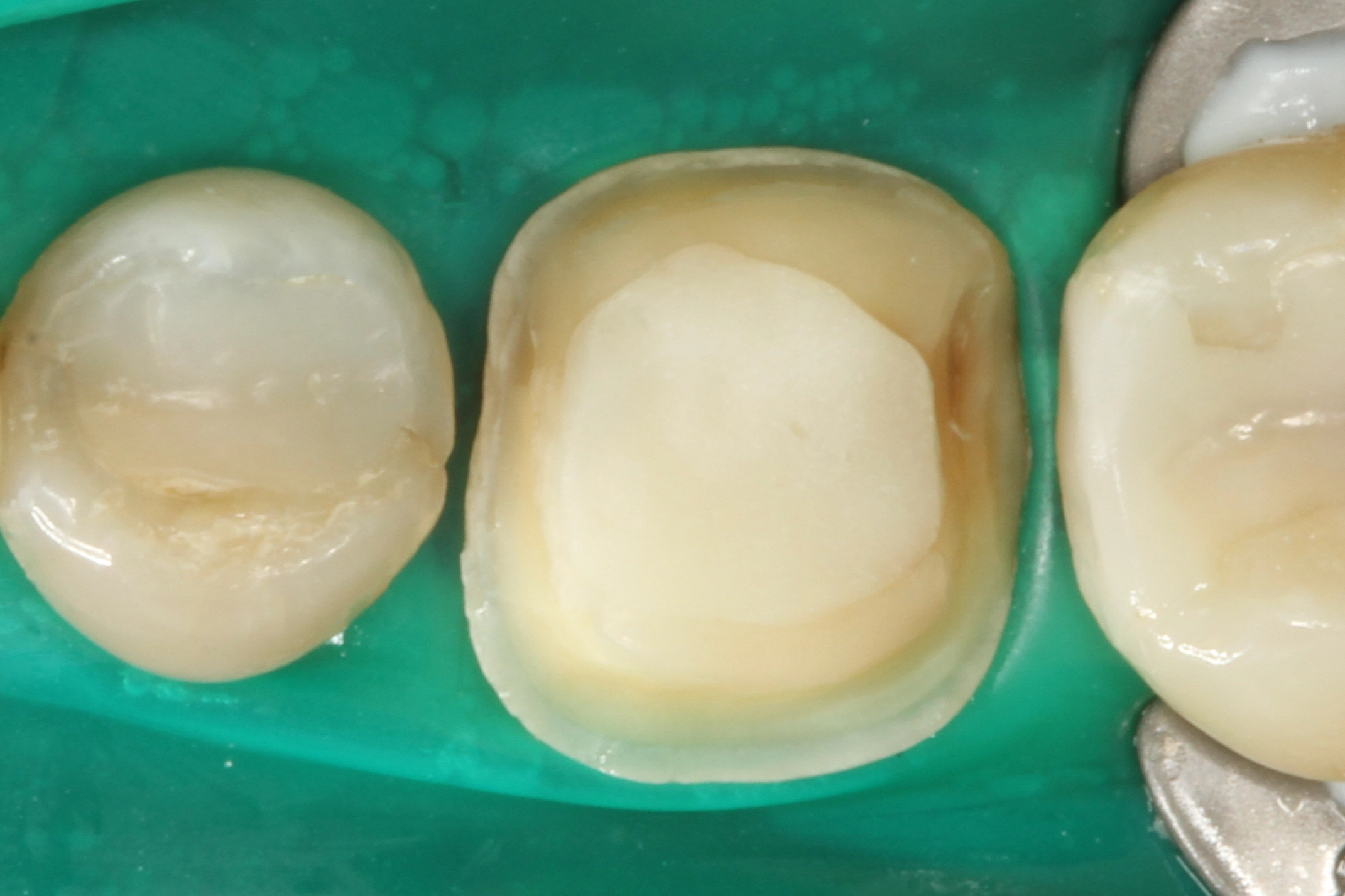 Abb. 8: Einwirken des Visalys Tooth Primers.