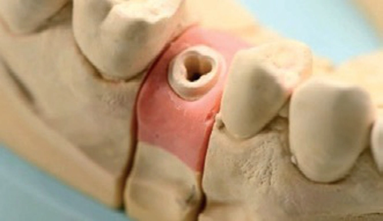 Abb. 8-10: Das Modell wird in Superhartgips mit evtl. Zahnfleischmaske ausgegossen (ohne Laboranalog). Man fixiert und präpariert den einzigartigen Glasfaser-Abutment-Aufbau, der im Lieferumfang enthalten ist und fertigt die Krone an.
