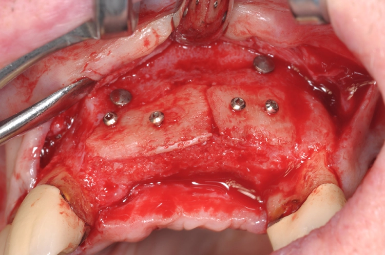 Abb. 8: Situation fünf Monate nach Operation in Alloschalentechnik.